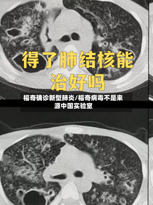福奇确诊新型肺炎/福奇病毒不是来源中国实验室-第3张图片