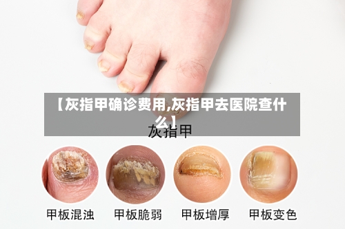 【灰指甲确诊费用,灰指甲去医院查什么】