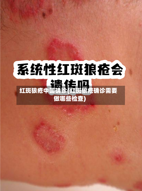 红斑狼疮中国确诊(红斑狼疮确诊需要做哪些检查)