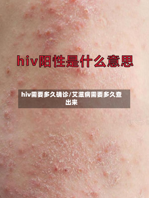hiv需要多久确诊/艾滋病需要多久查出来-第2张图片