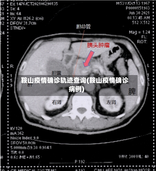 鞍山疫情确诊轨迹查询(鞍山疫情确诊病例)-第2张图片