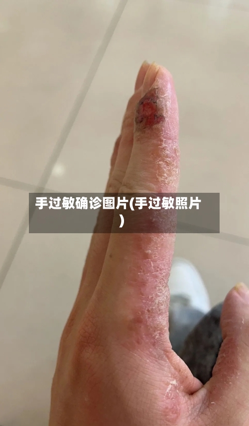 手过敏确诊图片(手过敏照片)