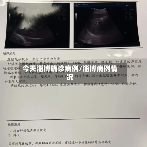 今天淄博确诊病例/淄博病例情况-第2张图片