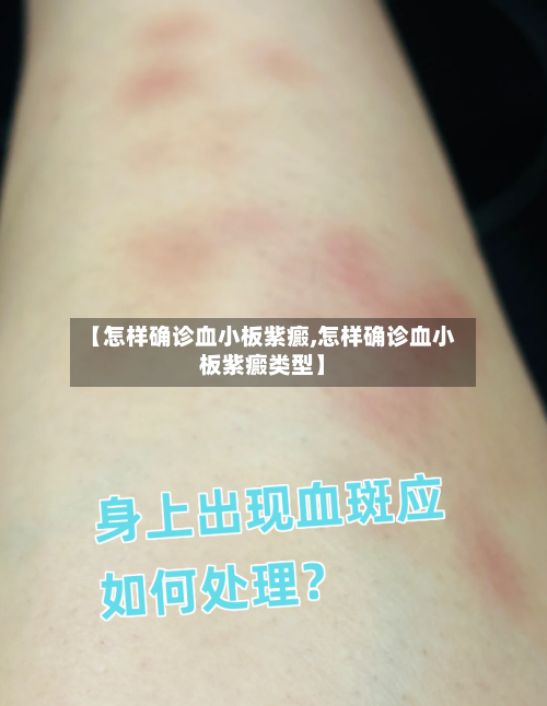 【怎样确诊血小板紫癜,怎样确诊血小板紫癜类型】-第2张图片