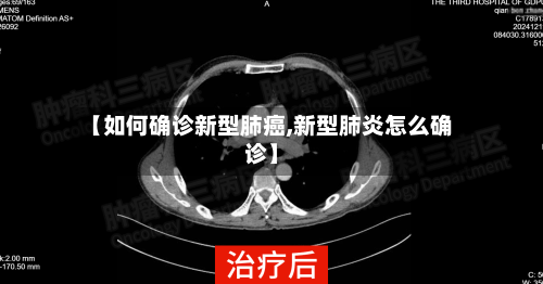 【如何确诊新型肺癌,新型肺炎怎么确诊】-第2张图片