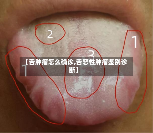 【舌肿瘤怎么确诊,舌恶性肿瘤鉴别诊断】-第2张图片