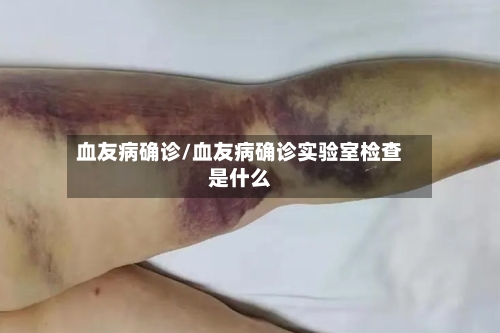 血友病确诊/血友病确诊实验室检查是什么