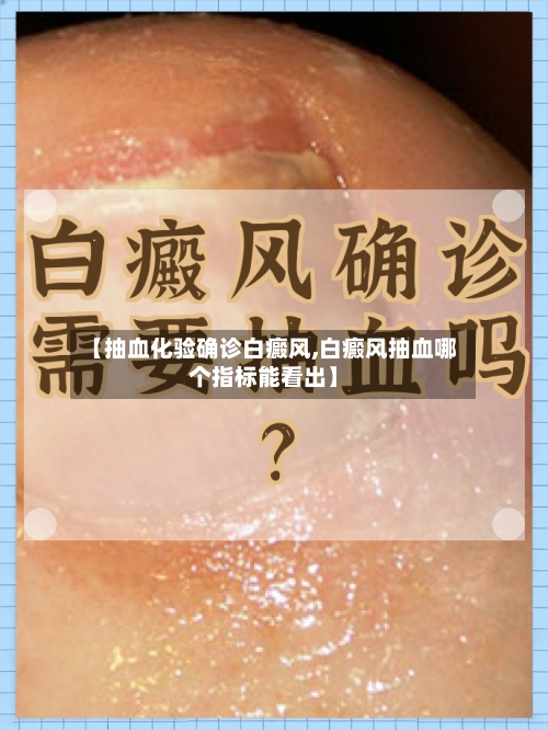 【抽血化验确诊白癜风,白癜风抽血哪个指标能看出】-第3张图片