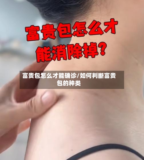 富贵包怎么才能确诊/如何判断富贵包的种类