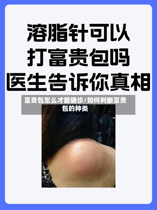 富贵包怎么才能确诊/如何判断富贵包的种类-第2张图片