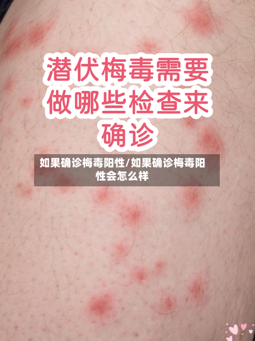 如果确诊梅毒阳性/如果确诊梅毒阳性会怎么样-第2张图片