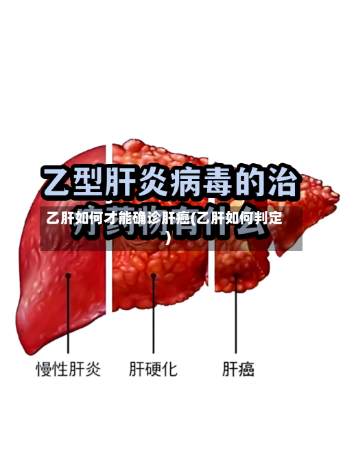 乙肝如何才能确诊肝癌(乙肝如何判定)
