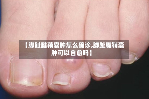 【脚趾腱鞘囊肿怎么确诊,脚趾腱鞘囊肿可以自愈吗】-第3张图片