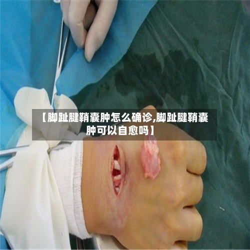 【脚趾腱鞘囊肿怎么确诊,脚趾腱鞘囊肿可以自愈吗】